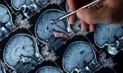Alzheimer'da 'Lecanemab' Mucizesi: 4 Yıl Geciktiriyor