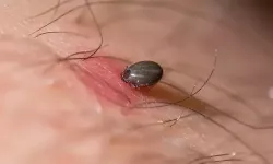 KKKA Tehlikesine Karşı Hayati Uyarı: Belirtileri Hafife Almayın