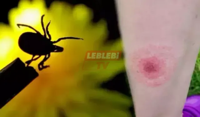 Kene Isırığı Nasıl Olur, Belirtileri Nelerdir? Kene Isırığı İzi Nasıl Görünür?