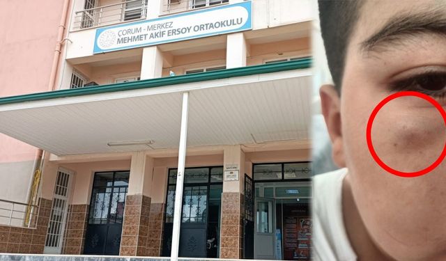 Akran Zorbalığı Bir Çocuğun Gözünü Şişirdi