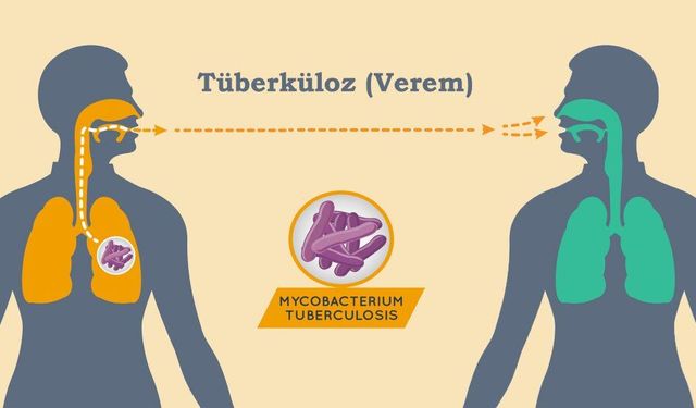 Verem (Tüberküloz) Hastalığında Devlet Yanınızda!