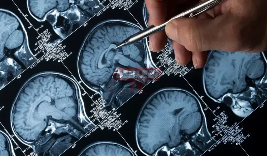 Alzheimer'da 'Lecanemab' Mucizesi: 4 Yıl Geciktiriyor